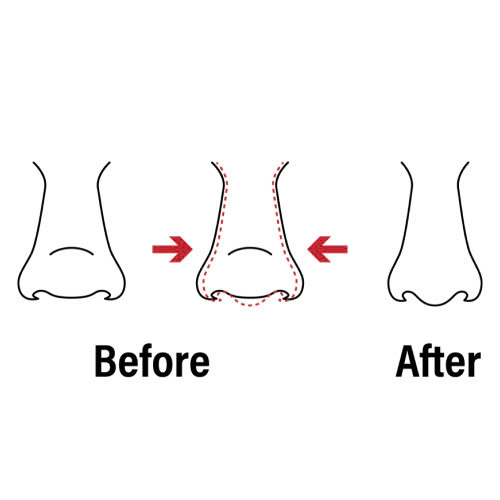 can-chinh-canh-mui-co-dau-khong-su-that-ban-nen-biet-truoc-khi-thuc-hien