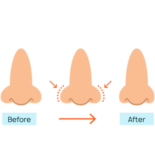 can-chinh-canh-mui-giu-duoc-bao-lau-co-the-duy-tri-vinh-vien-khong