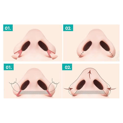 cung-tim-hieu-quy-trinh-chinh-canh-mui-rong-hieu-qua