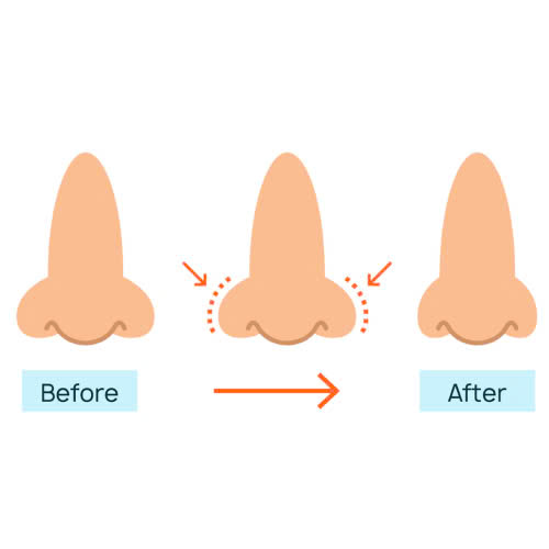 co-nen-can-chinh-canh-mui-khong-bat-mi-cac-phuong-phap-khong-phau-thuat-an-toan-tai-nha