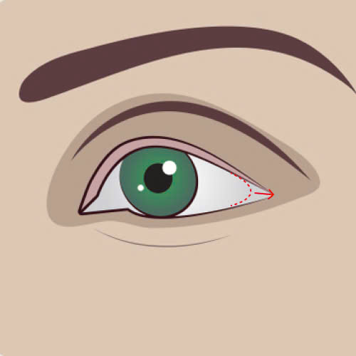 co-nen-mo-goc-mat-ngoai-khong-nhung-ai-nen-va-khong-nen-thuc-hien-phuong-phap-nay