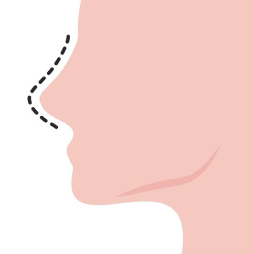 co-nen-tiem-filler-mui-khong-nhung-dieu-ban-nhat-dinh-phai-biet-truoc-khi-quyet-dinh