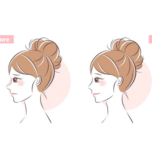 co-nen-tiem-filler-mui-khong-nhung-dieu-ban-nhat-dinh-phai-biet-truoc-khi-quyet-dinh