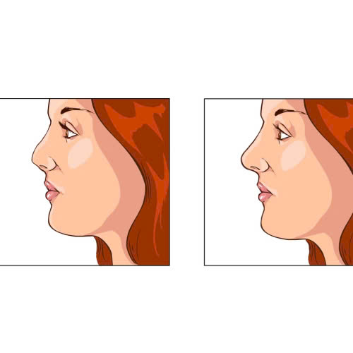 filler-mui-loai-nao-tot-nhat-bat-mi-bi-quyet-chon-dung-de-dang-mui-dep-tu-nhien-an-toan
