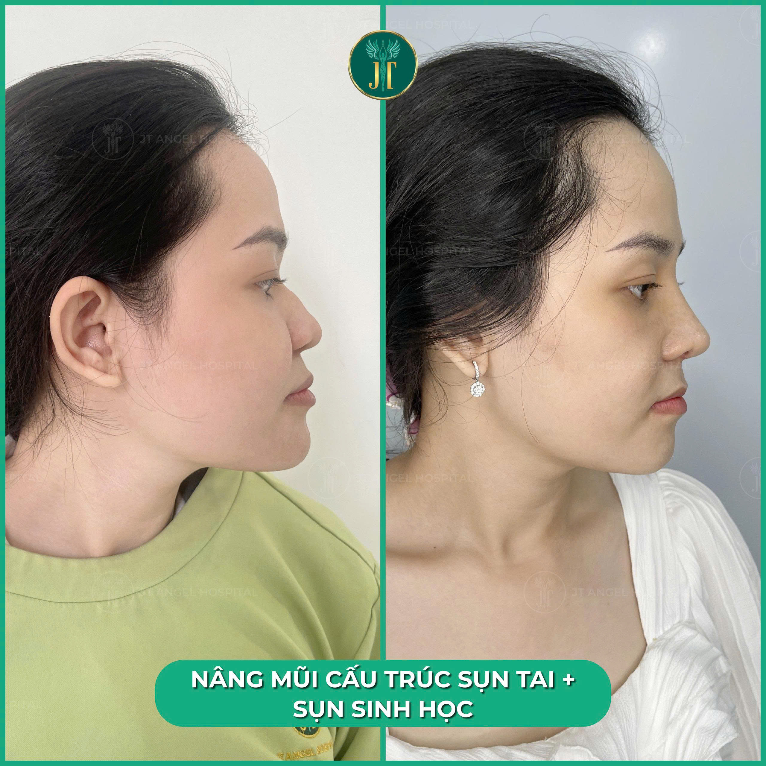 he-lo-hinh-anh-truoc-sau-khi-mai-go-mui-guong-mat-cua-ban-se-thay-doi-nhu-the-nao