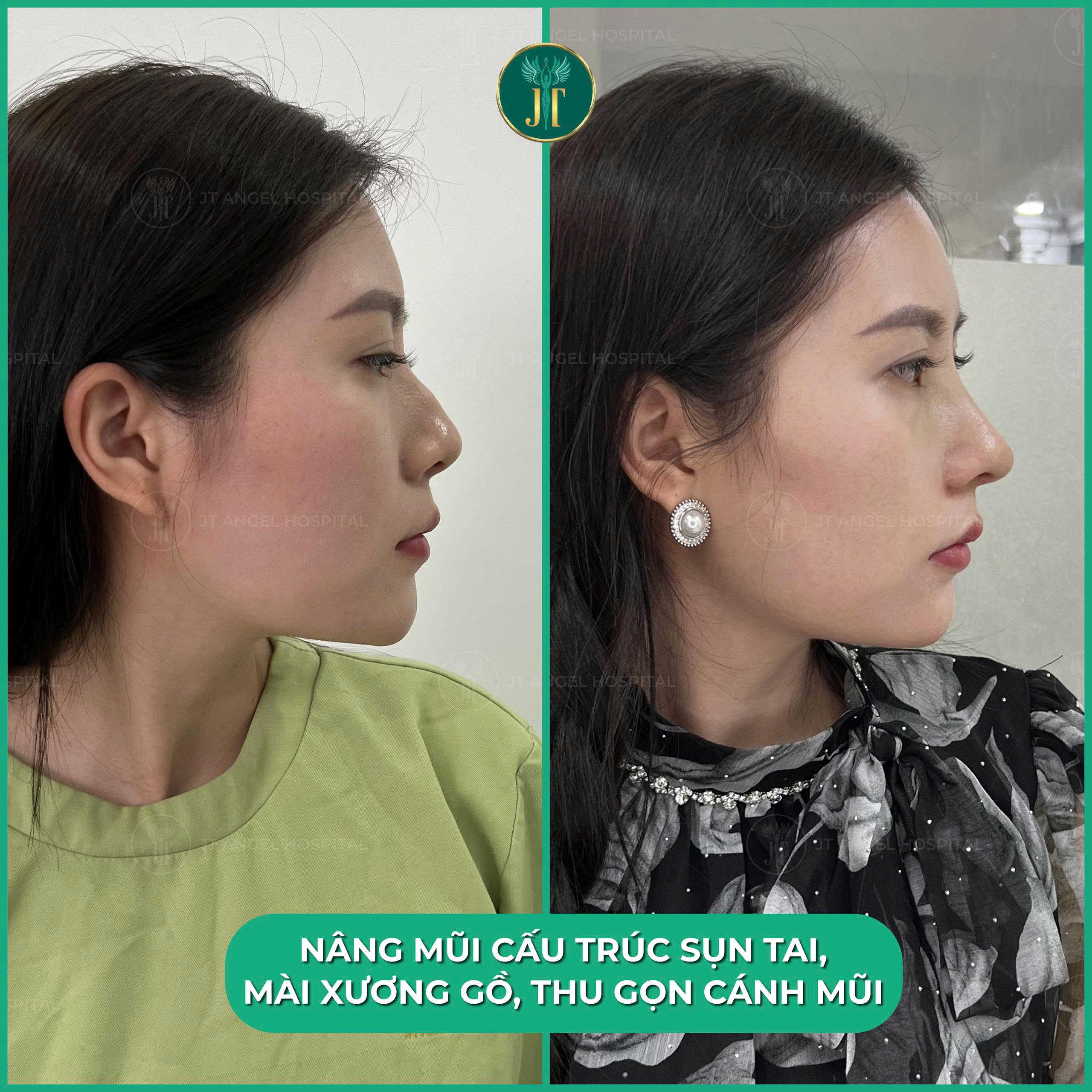 he-lo-hinh-anh-truoc-sau-khi-mai-go-mui-guong-mat-cua-ban-se-thay-doi-nhu-the-nao