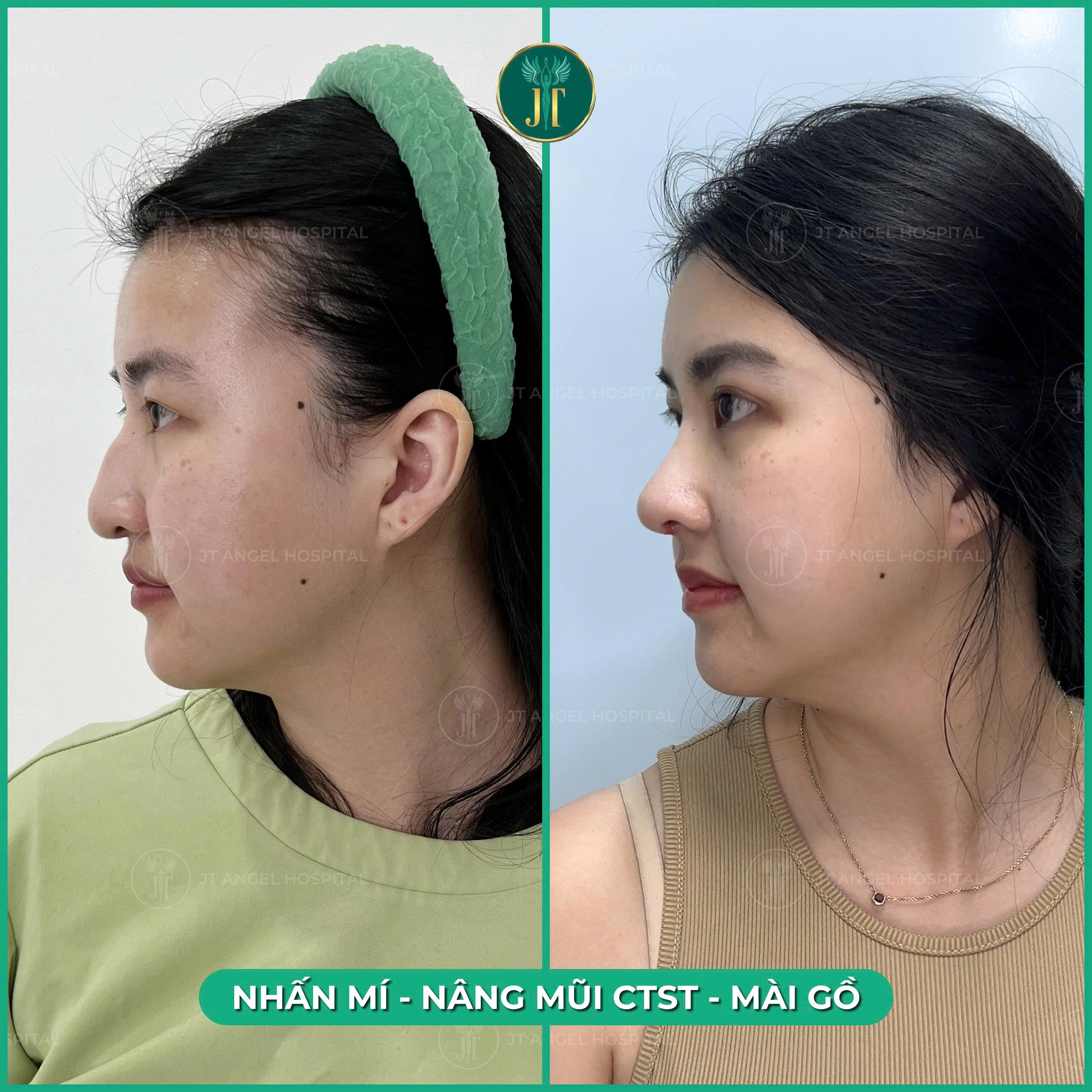 he-lo-hinh-anh-truoc-sau-khi-mai-go-mui-guong-mat-cua-ban-se-thay-doi-nhu-the-nao