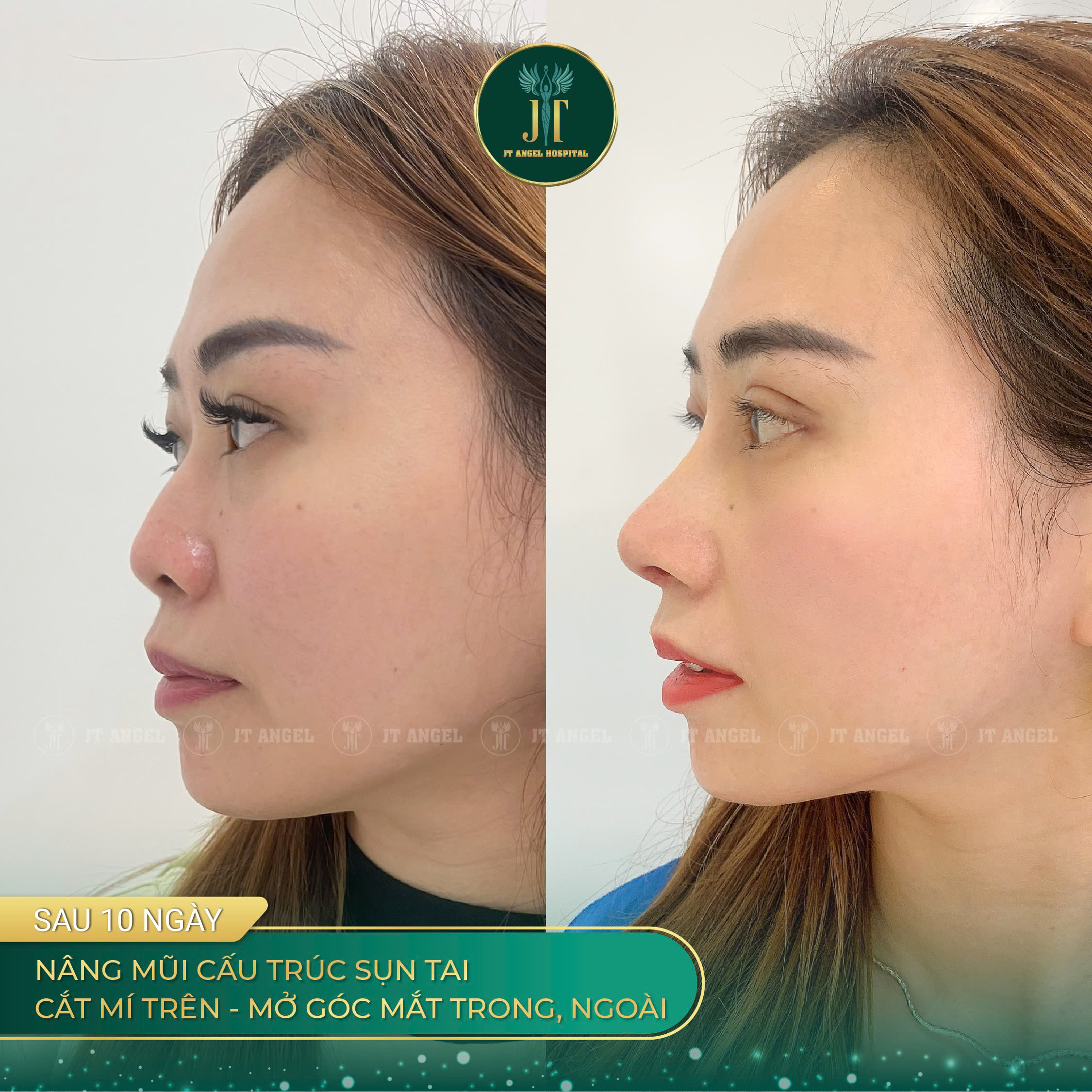 hinh-anh-truoc-sau-mo-goc-mat-ngoai-bi-quyet-giup-doi-mat-to-tron-sac-net-hon-ro-ret