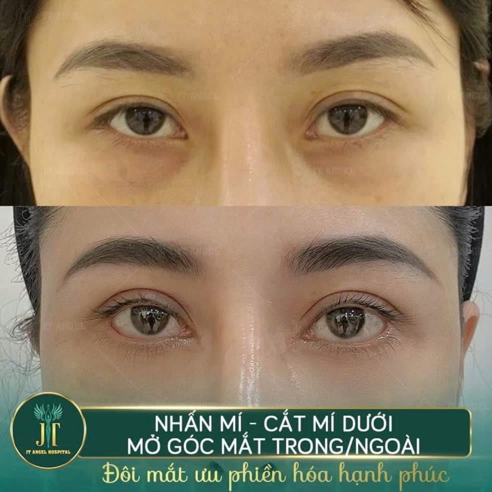 hinh-anh-truoc-sau-mo-goc-mat-ngoai-bi-quyet-giup-doi-mat-to-tron-sac-net-hon-ro-ret