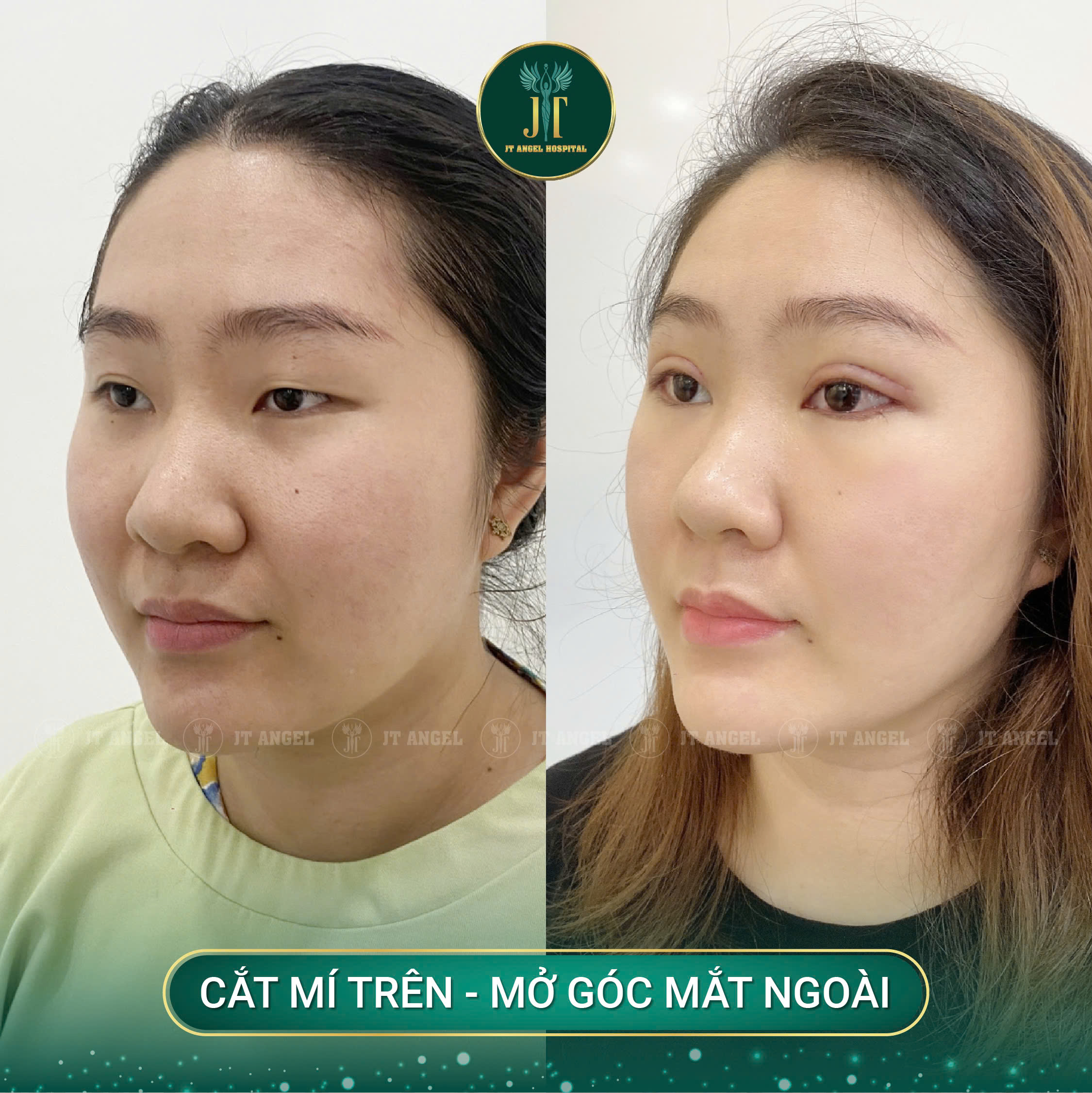 hinh-anh-truoc-sau-mo-goc-mat-ngoai-bi-quyet-giup-doi-mat-to-tron-sac-net-hon-ro-ret