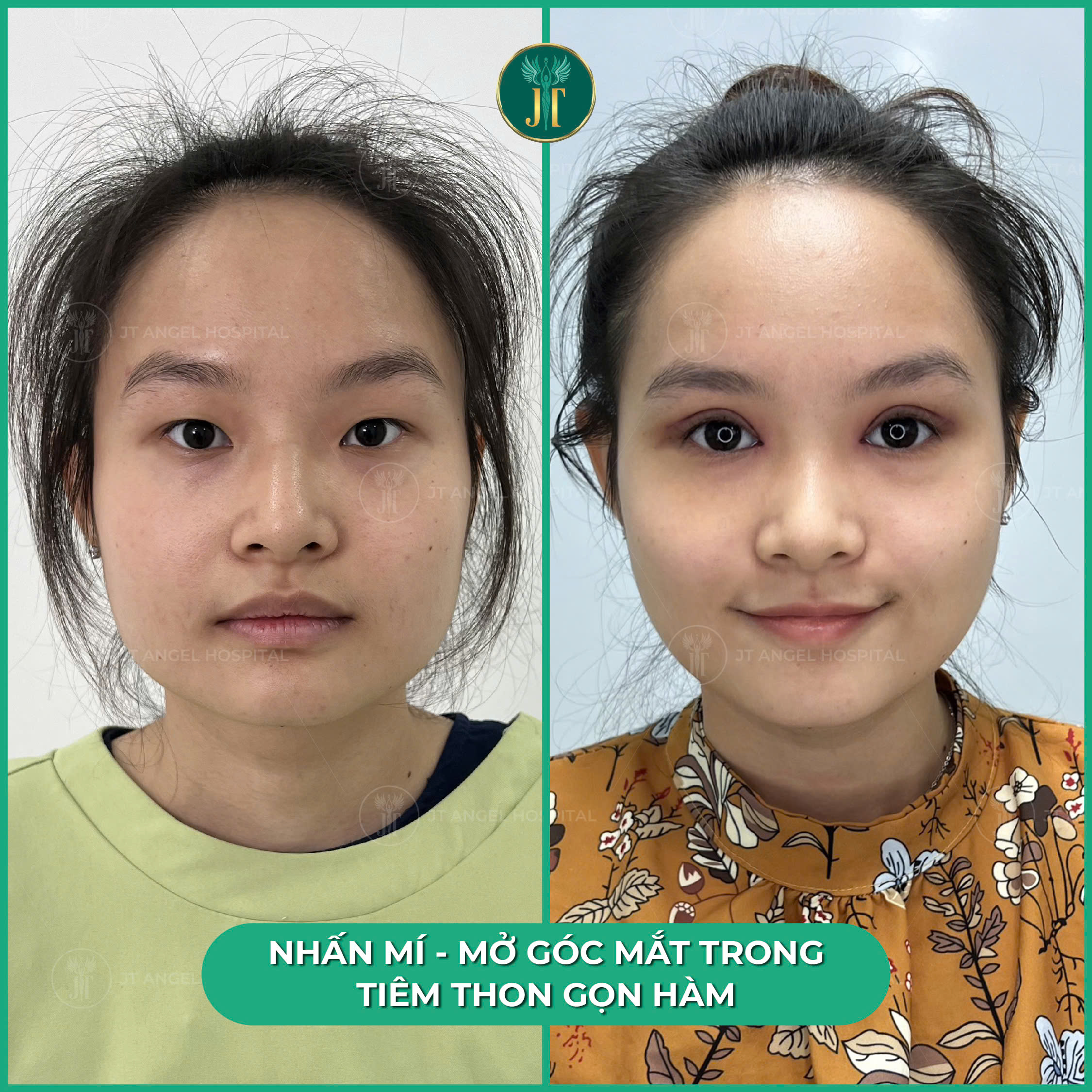 hinh-anh-truoc-sau-mo-goc-mat-trong-cai-nhin-ro-net-cho-quyet-dinh-lam-dep-cua-ban