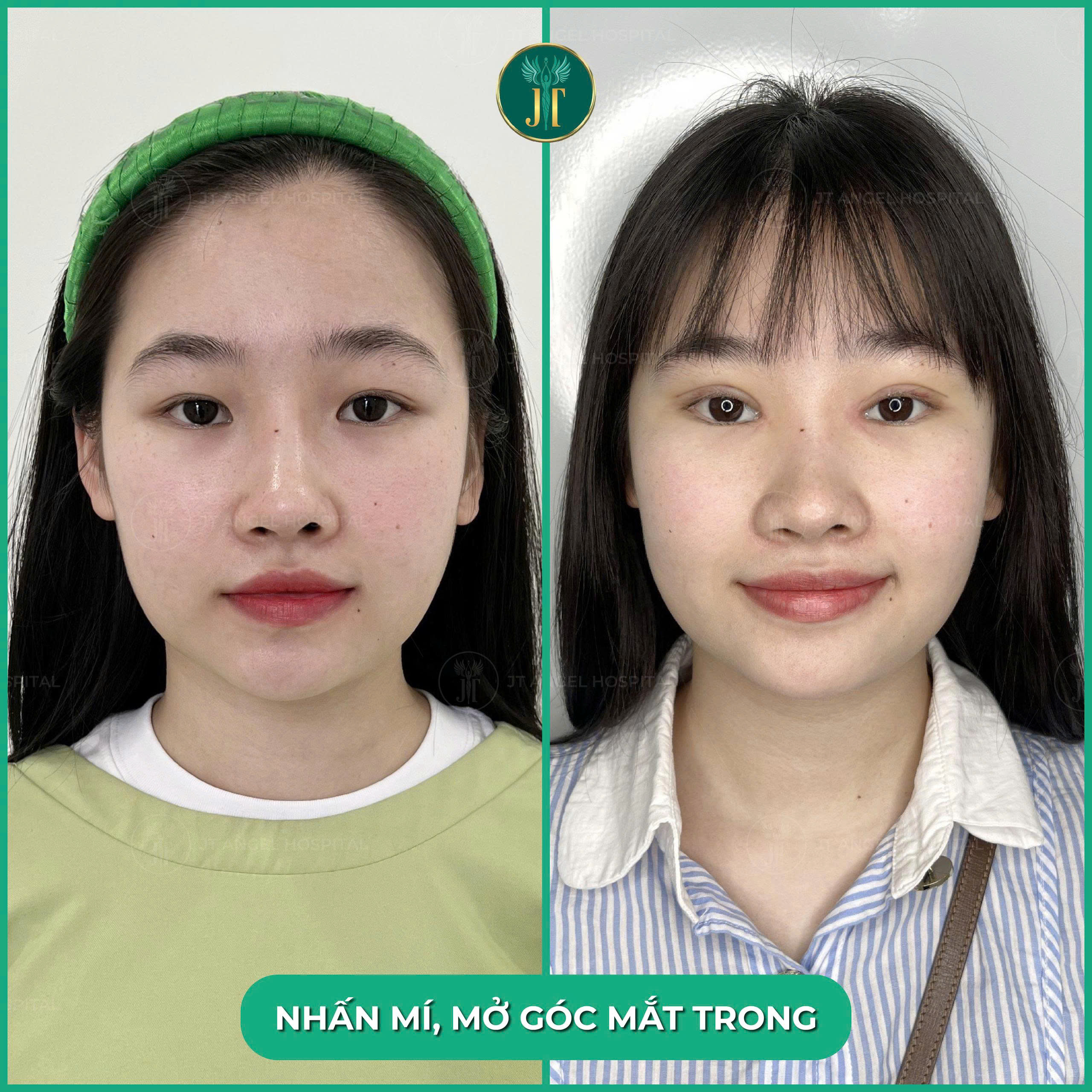 hinh-anh-truoc-sau-mo-goc-mat-trong-cai-nhin-ro-net-cho-quyet-dinh-lam-dep-cua-ban