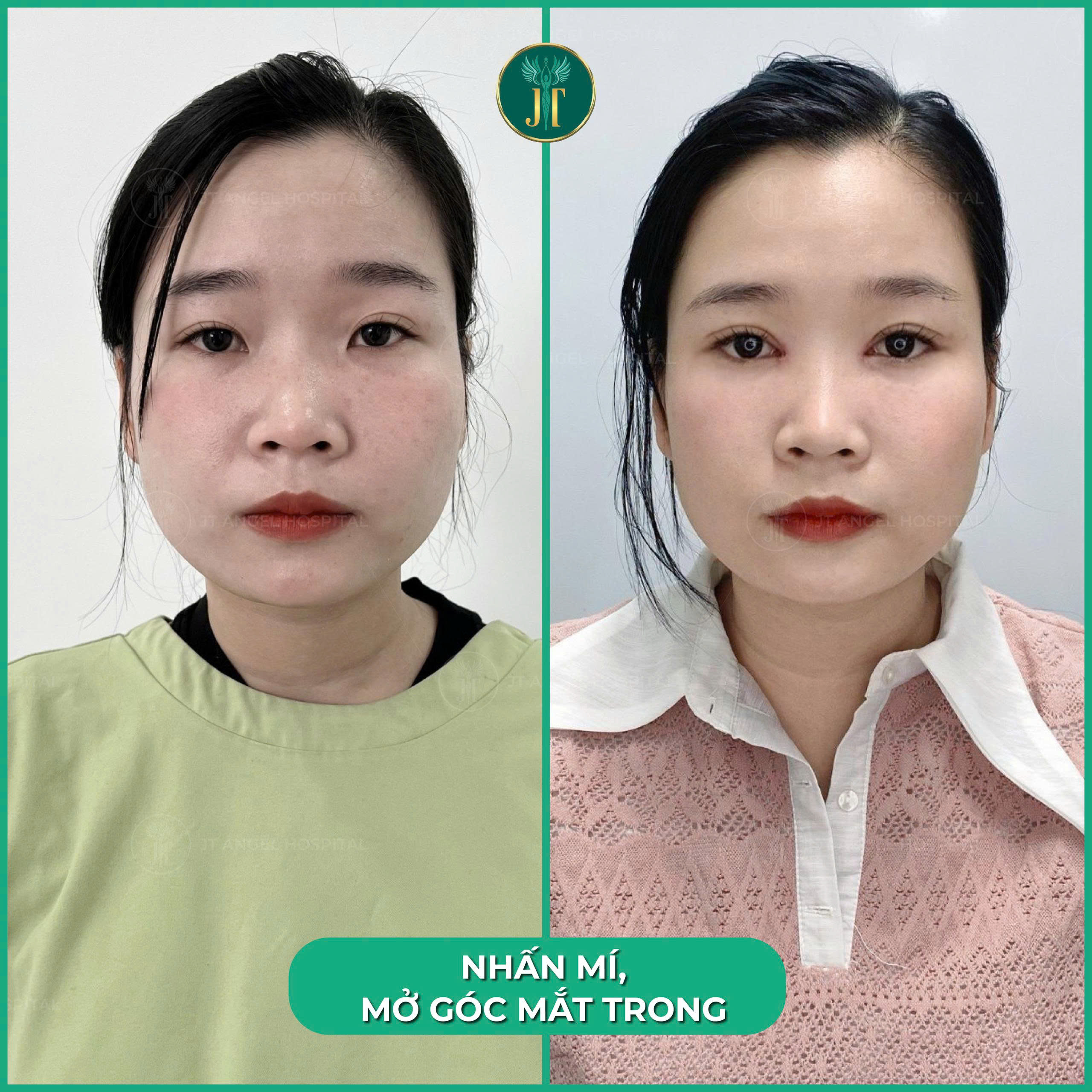 hinh-anh-truoc-sau-mo-goc-mat-trong-cai-nhin-ro-net-cho-quyet-dinh-lam-dep-cua-ban