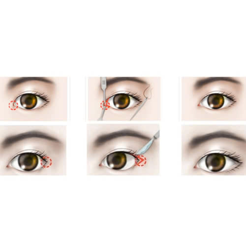 co-nen-ket-hop-mo-goc-mat-trong-va-ngoai-khong-nhung-dieu-ban-can-biet-truoc-khi-lam