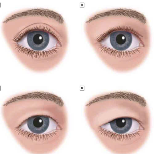 co-nen-ket-hop-mo-goc-mat-trong-va-ngoai-khong-nhung-dieu-ban-can-biet-truoc-khi-lam