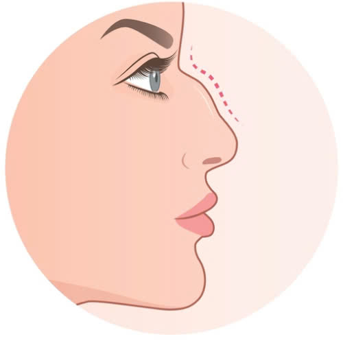 phuong-phap-khac-phuc-mui-go-ma-khong-can-phau-thuat-phu-hop-voi-nhung-ai