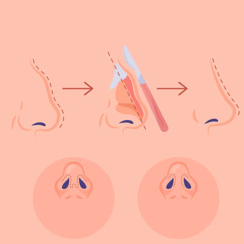 mai-go-mui-gia-bao-nhieu-giai-dap-chi-tiet-cho-cho-nguoi-co-y-dinh-tham-my