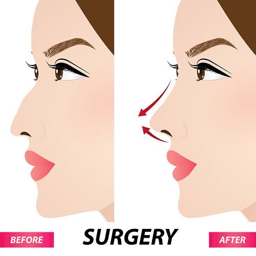 mai-go-mui-giu-duoc-bao-lau-giai-dap-chi-tiet-cho-nguoi-dang-muon-cai-thien-dang-mui-go