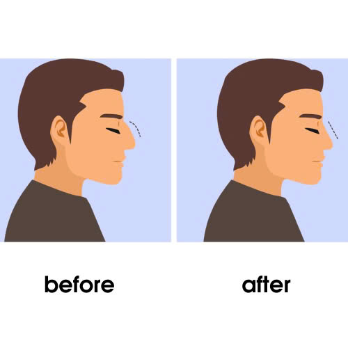 mai-go-mui-giu-duoc-bao-lau-giai-dap-chi-tiet-cho-nguoi-dang-muon-cai-thien-dang-mui-go