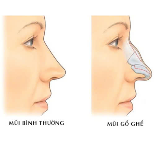 mai-go-mui-o-dau-dep-an-toan-va-uy-tin-hien-nay