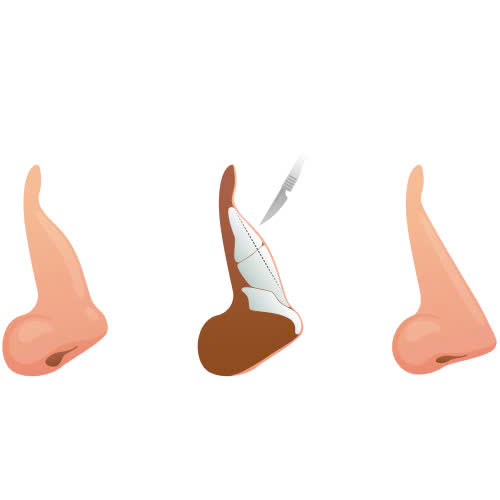 mai-go-mui-o-dau-dep-an-toan-va-uy-tin-hien-nay