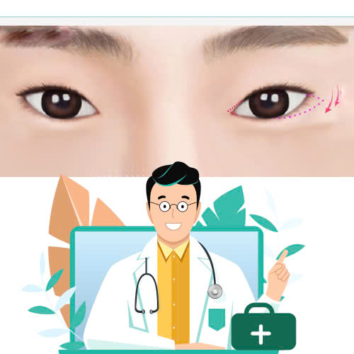 mo-goc-mat-khac-phuc-mat-xech-giai-phap-tinh-chinh-anh-nhin-tro-nen-hai-hoa-va-cuon-hut