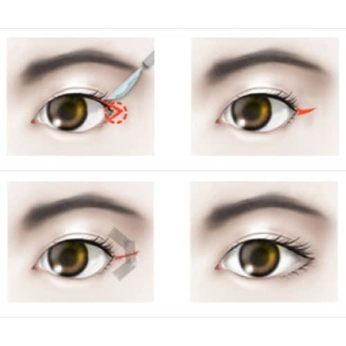 mo-goc-mat-ngoai-bao-lau-het-sung-va-cach-rut-ngan-thoi-gian-phuc-hoi