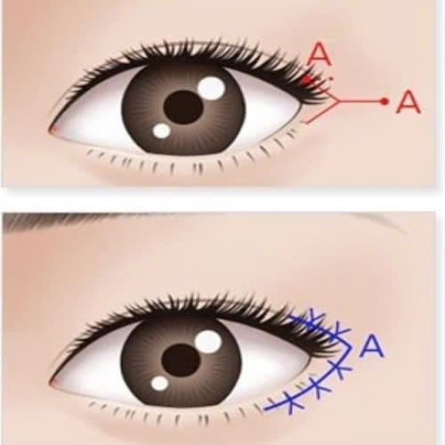 mo-goc-mat-ngoai-bi-rut-lai-nguyen-nhan-hau-qua-va-cach-khac-phuc-hieu-qua