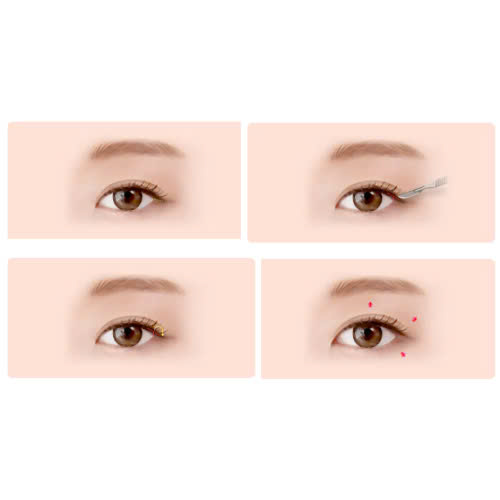 mo-goc-mat-ngoai-bi-seo-khong-cach-cham-soc-giup-lanh-nhanh-khong-dau-vet