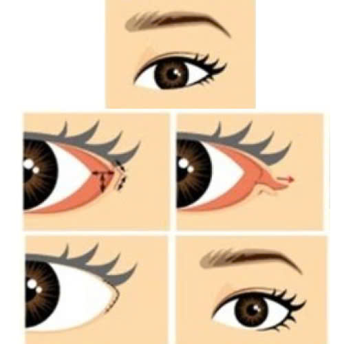 mo-goc-mat-ngoai-cho-mat-ngan-giai-phap-giup-doi-mat-to-tron-thu-hut-hon