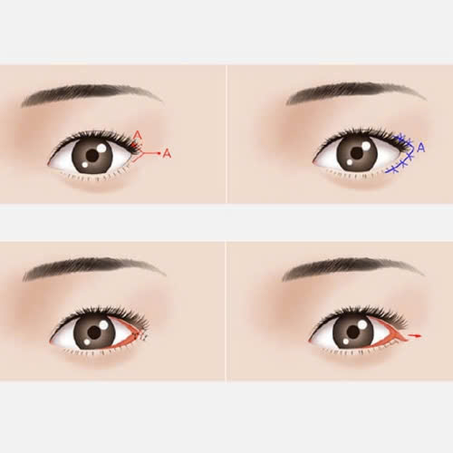 mo-goc-mat-ngoai-co-dau-khong-nhung-su-that-ban-nen-biet-truoc-khi-quyet-dinh