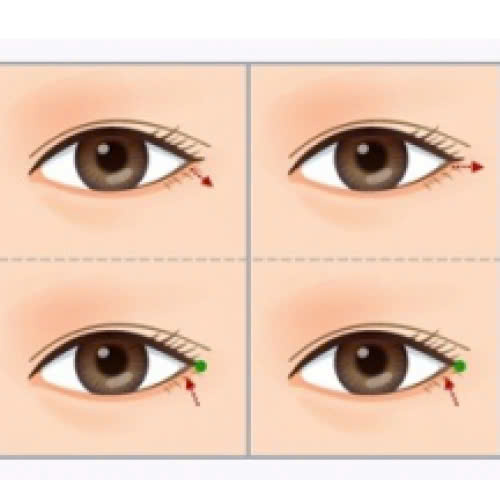 mo-goc-mat-ngoai-co-dau-khong-nhung-su-that-ban-nen-biet-truoc-khi-quyet-dinh