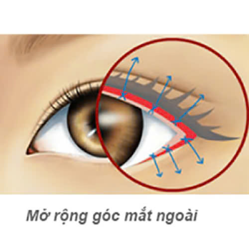 mo-goc-mat-ngoai-co-giu-duoc-lau-khong-nhung-yeu-to-quyet-dinh-ban-nen-biet