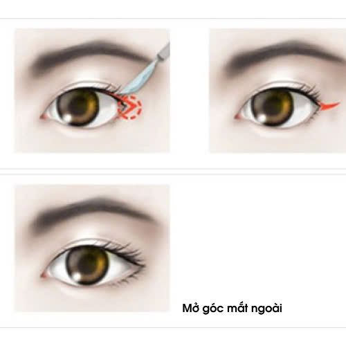 mo-goc-mat-ngoai-giup-mat-dai-hon-khong-su-that-ban-nen-biet-truoc-khi-lam-dep