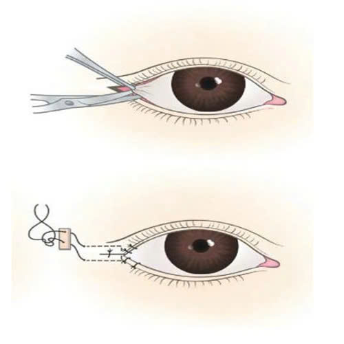 mo-goc-mat-ngoai-giup-mat-dai-hon-khong-su-that-ban-nen-biet-truoc-khi-lam-dep