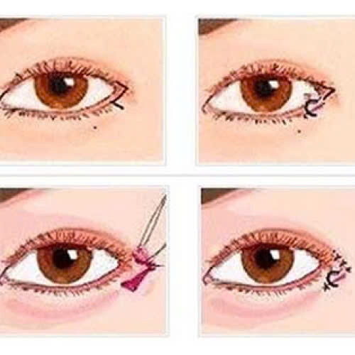 mo-goc-mat-ngoai-la-gi-tat-ca-thong-tin-ban-can-biet-truoc-khi-thuc-hien