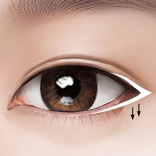 mo-goc-mat-ngoai-la-gi-tat-ca-thong-tin-ban-can-biet-truoc-khi-thuc-hien