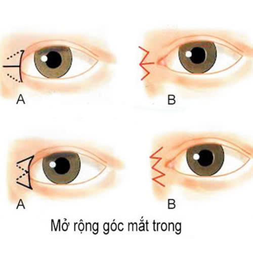 mo-goc-mat-trong-bao-lau-thi-lanh-he-lo-thoi-gian-hoi-phuc-thuc-te-va-cach-cham-soc-chuan-y-khoa