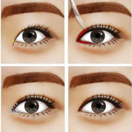 mo-goc-mat-trong-bi-bien-chung-nguyen-nhan-dau-hieu-va-cach-khac-phuc-an-toan