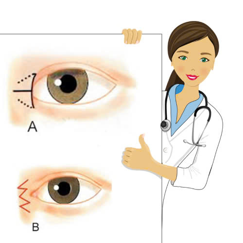 mo-goc-mat-trong-bi-bien-chung-nguyen-nhan-dau-hieu-va-cach-khac-phuc-an-toan