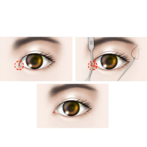 mo-goc-mat-trong-bi-seo-khong-su-that-ban-can-biet-truoc-khi-thuc-hien