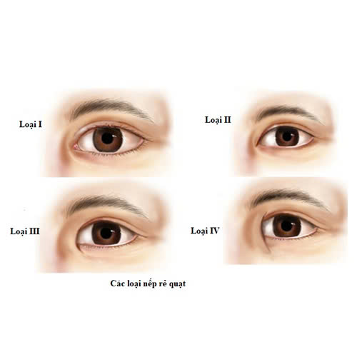 mo-goc-mat-trong-bi-seo-khong-su-that-ban-can-biet-truoc-khi-thuc-hien