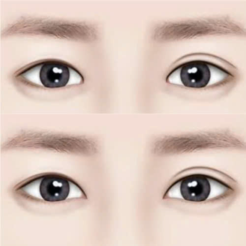 mo-goc-mat-trong-cho-mat-nho-giai-phap-tham-my-tinh-te-de-doi-mat-trong-to-tron-cuon-hut