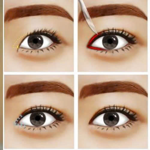 mo-goc-mat-trong-co-dau-khong-nhung-dieu-ban-can-biet-truoc-khi-thuc-hien