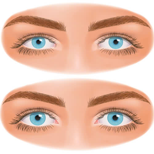 mo-goc-mat-trong-giup-mat-to-hon-khong-su-that-ban-can-biet-truoc-khi-tham-my