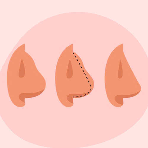 mui-bi-go-phai-lam-sao-3-cach-khac-phuc-hieu-qua-giup-ban-tu-tin-hon-moi-ngay