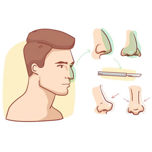 mui-go-nhe-co-can-mai-khong-nhung-dieu-ban-can-biet-truoc-khi-quyet-dinh