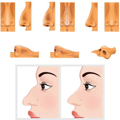 phau-thuat-mai-go-mui-giai-phap-giup-hoan-thien-dang-mui-hai-hoa-va-thanh-thoat