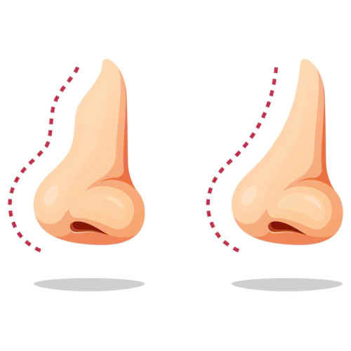phau-thuat-mai-go-mui-giai-phap-giup-hoan-thien-dang-mui-hai-hoa-va-thanh-thoat