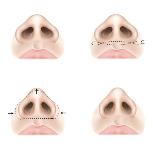 review-can-chinh-canh-mui-co-dau-khong-gia-bao-nhieu-bao-lau-thi-lanh